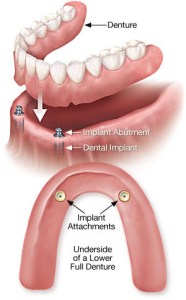 Implant Overdentures