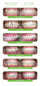 Clear Braces Before and After