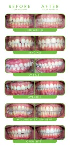Clear Braces Before and After
